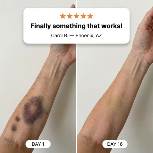 AxonRelief- Finally, A Balm That Fades Bruises On Fragile Skin